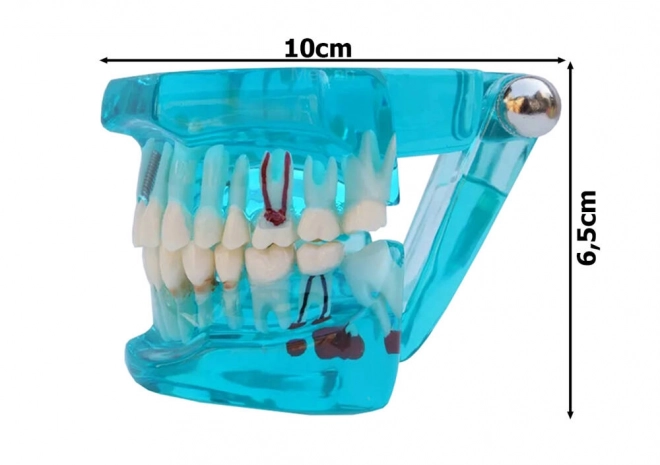 fogászati modell állcsont és fogak implantátumokkal